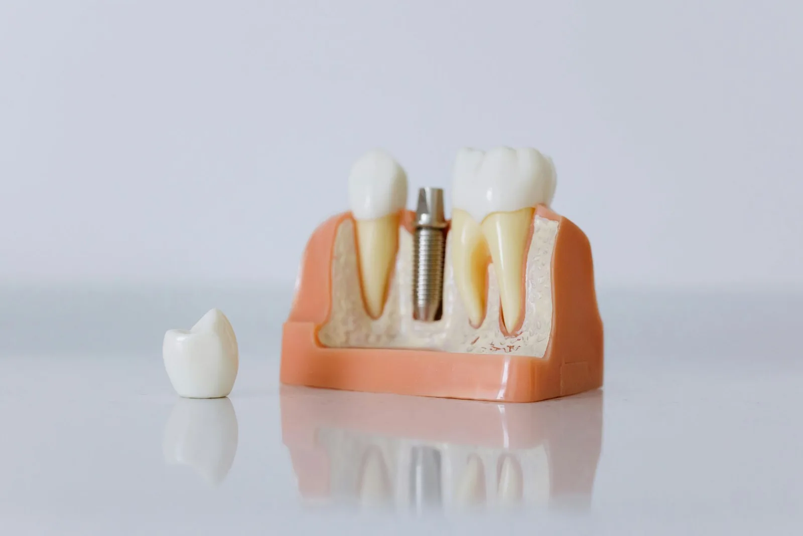 Dental model showing an implant post between natural teeth beside a loose crown